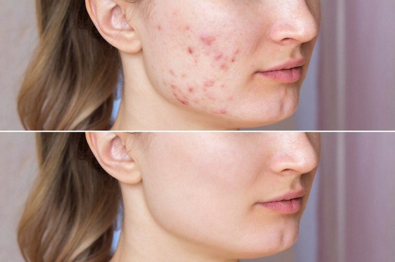 Roaccutane (isotrétinoïne) : l’ANSM alerte sur les usages esthétiques dangereux