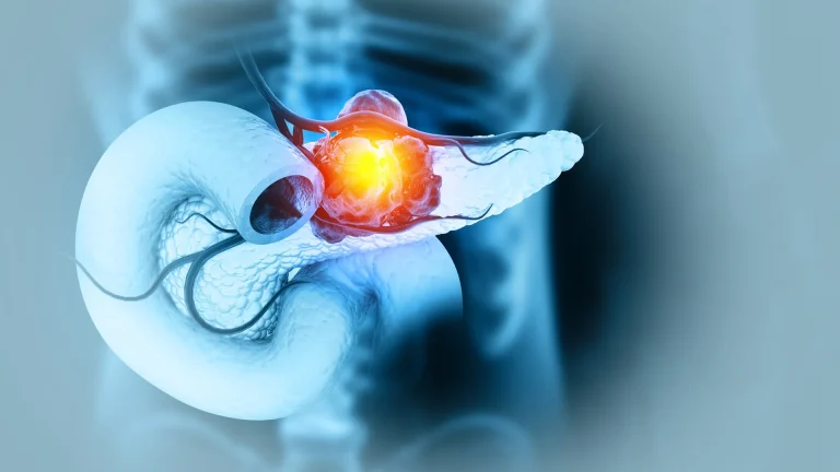 Cancer du pancréas : cette avancée qui redonne espoir